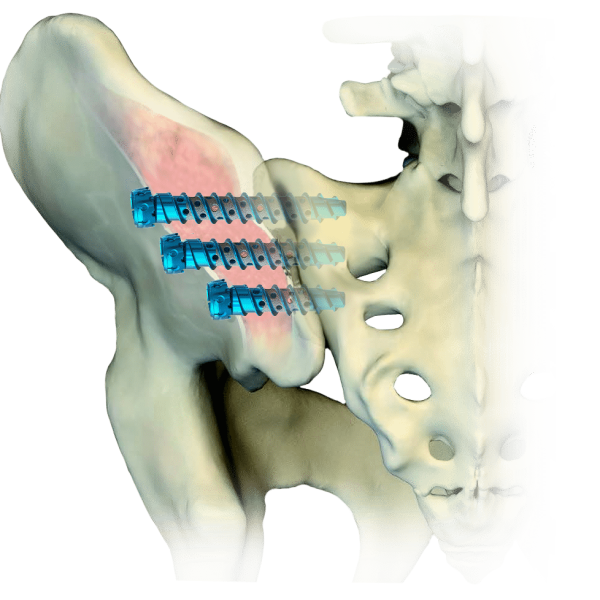 screws in pelvis